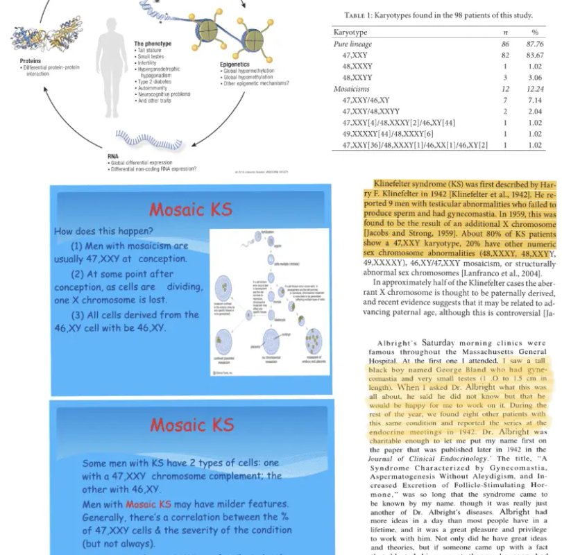 Mosaic Klinefelter Syndrome infographic by Russell Martin