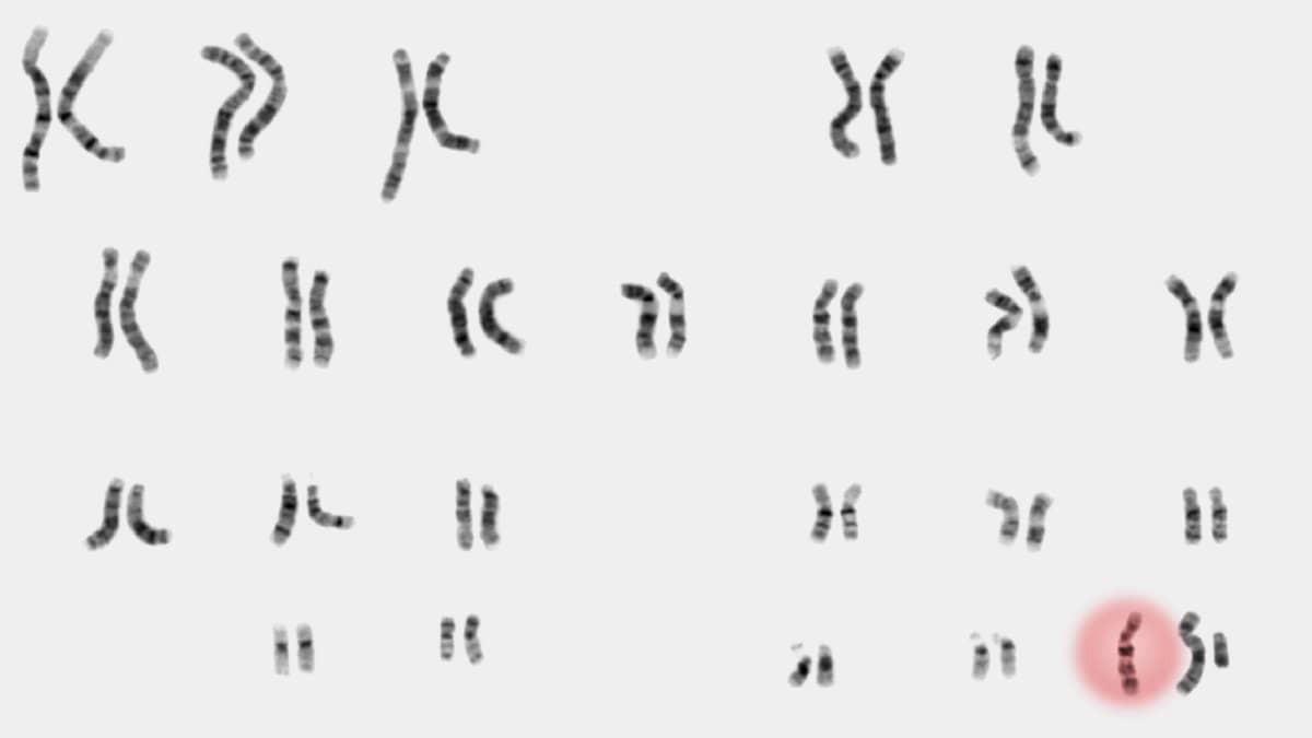 What to expect when you’re expecting an extra X or Y chromosome