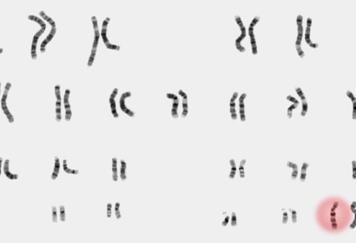 What to expect when you’re expecting an extra X or Y chromosome